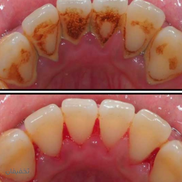 جرمگیری بروساژ کامل فک در مطب دندانپزشکی دکتر فیروزان
