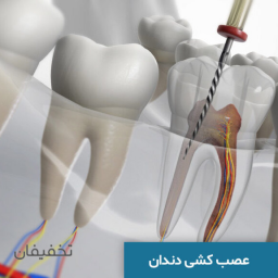 عصب کشی تک کانال  و ترمیم