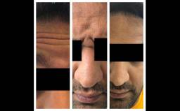 میکرودرم ابریژن توسط دکتر قره داغی