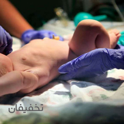ختنه به روش حلقه 