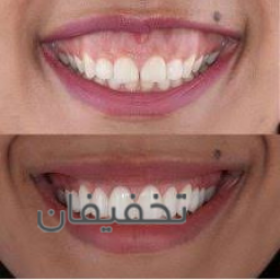 بوتاکس لبخند لثه ای