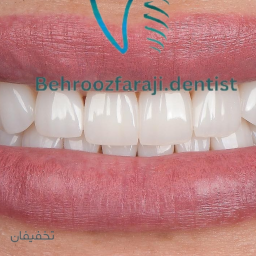 ایمپلنت درجه 1 سویسی بدون درد و جراحی و خونریزی 15 دقیقه ای