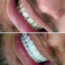لمینیت توسط جراح دندانپزشک دکتر ماندانا حمزه ای 