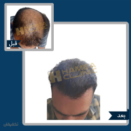 ویزیت و مشاوره رایگان کاشت مو + 10 درصد تخفیف کاشت مو