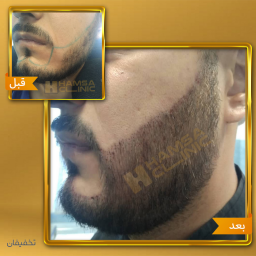 ویزیت و مشاوره رایگان کاشت ریش و سبیل + 10 درصد تخفیف کاشت ریش و سبیل
