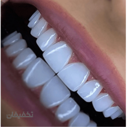 کامپوزیت درجه 1 ویژه