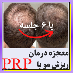 پی آر پی PRP مو و صورت: ضد ریزش مو، رویش دهنده مو، جوانساز و ضد چروک و پیری: یکی بخر دوتا ببر