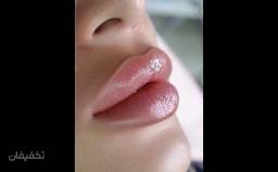تزریق فیلر لب