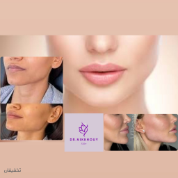 فیلر نواحی صورت( خط لبخند و غم، گونه، زاویه فک، چانه و.....)از برندهای اصل کره و ایتالیا(هر 1سی سی) 