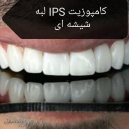 20 واحد دندان، زیبائی، تکنیک جدید لیرینگ
