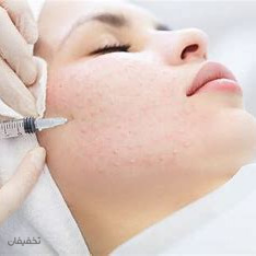 یک جلسه مزوتراپی ضد لک و روشن کننده، با استفاده از کوکتل F-RADIANCE از برند فیوژن اسپانیا 