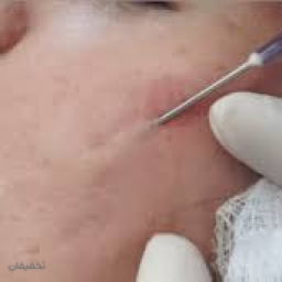 سابسیژن برای رفع اسکار فرورفته ناشی از جوشهای قدیمی ، آبله مرغان و زخمها