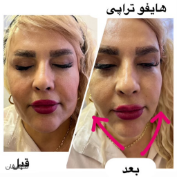 تخفیف هایفو 12 بعدی