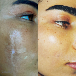 مزونیدلینگ و پلاسماجت ( پلکسر) تخصصی