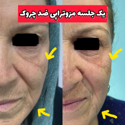 درمان ترکیبی جوانسازی و رفع چین و چروک