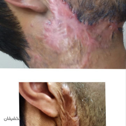 مزونیدلنگ درمانی