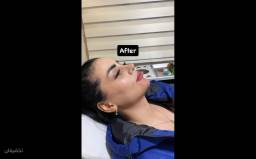 تزریق فیلر چانه