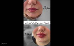 تزریق فیلر لب