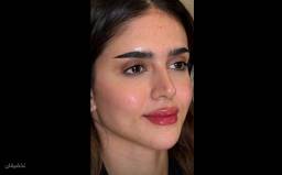 تزریق فیلر فول فیس