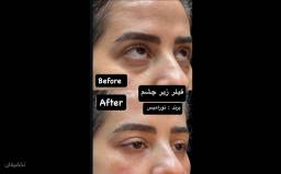 تزریق فیلر زیر چشم