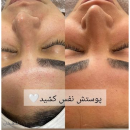 تخفیف.میکرونیدلینگ به مدت یک هفته 