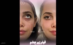 فیلر صورت 1 سی سی