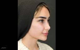 رینو بینی اول