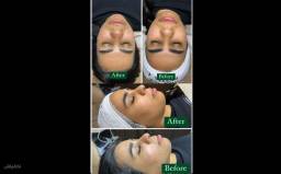 فیشال تخصصی درمان جوش صورت میترا