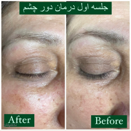 فیشال تخصصی دور چشم