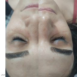 میکرودرم ابریژن به همراه ماسک