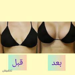 ماستوپکسی لیفت سینه/ بدون هزینه بیمارستان 