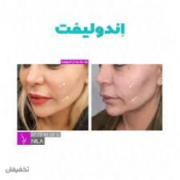 لیزر اندولیفت کامل 