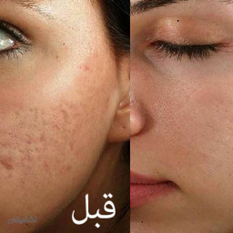 مزونیدلینگ هر سی سی 