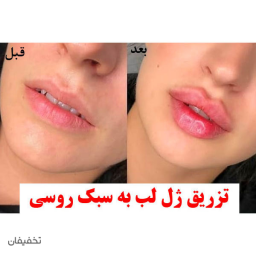 ژل لب /چانه/گونه/خط خنده/ هرسی سی 