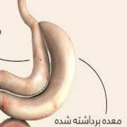 بوتاکس معده 