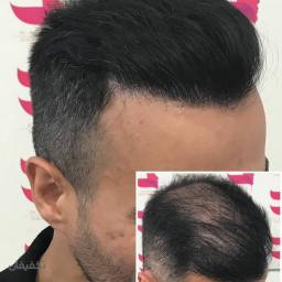 PRP