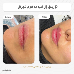 تزریق ژل