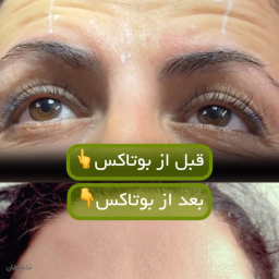 بوتاکس فول فیس دیستون 