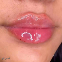 تزریق ژل لب (نورافیل) هر سی سی