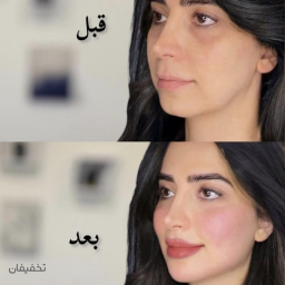 مزوتراپي مو 