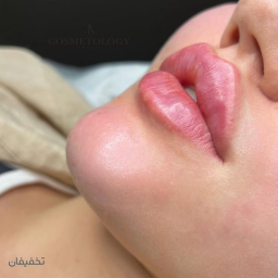فیلر کره ای 900.000 تومان ( هر نیم سی سی)