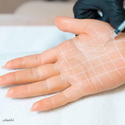 بوتاکس تعریق کف دست و پا