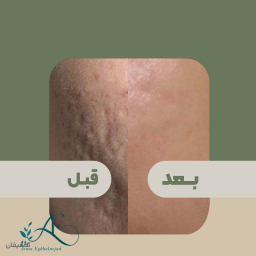 جوانسازی و لیفت پوست با ترمیا