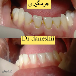 جرمگیری و بروساژ هر  دو فک در مطب دکتر دانشی با 70% تخفیف