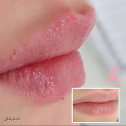 تزریق فیلر