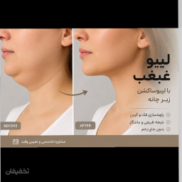 برداشت غبغب به روش ساکشن (Submental Liposuction) 
