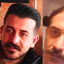 کاشت مو سر