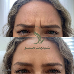بوتاکس زیر بغل