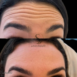 بوتاکس صورت