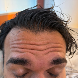 ژل و بوتاکس
